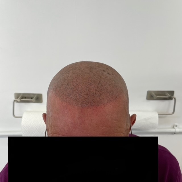 Scalp micropigmentation result by Micro Magic SMP Manchester