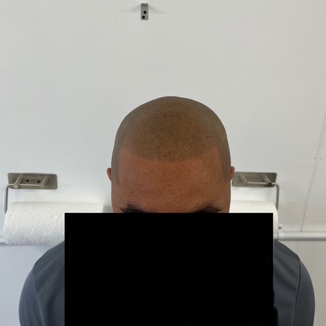 Scalp micropigmentation result by Micro Magic SMP Manchester