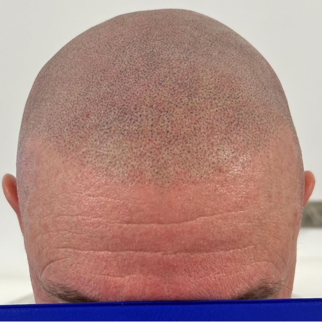 Scalp micropigmentation result by Micro Magic SMP Manchester