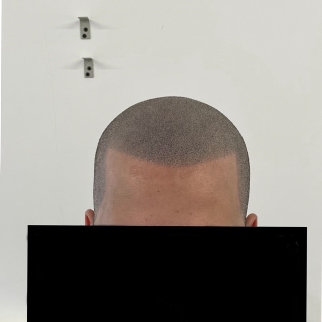 Scalp micropigmentation result by Micro Magic SMP Manchester
